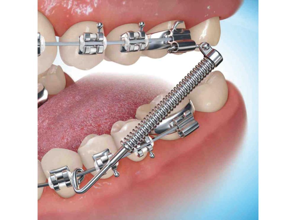 Forsus™ Class II Corrector, L-Pin Module, 1-Patient-Kit, Push Rod Medium (29 mm)