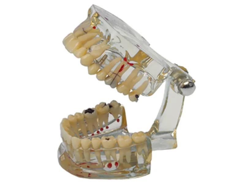 Modele D Etude Dents Malades