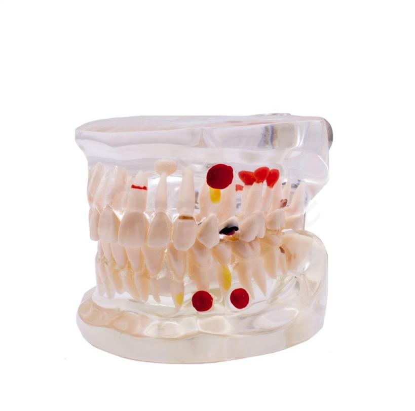 Type démonstratif Caries