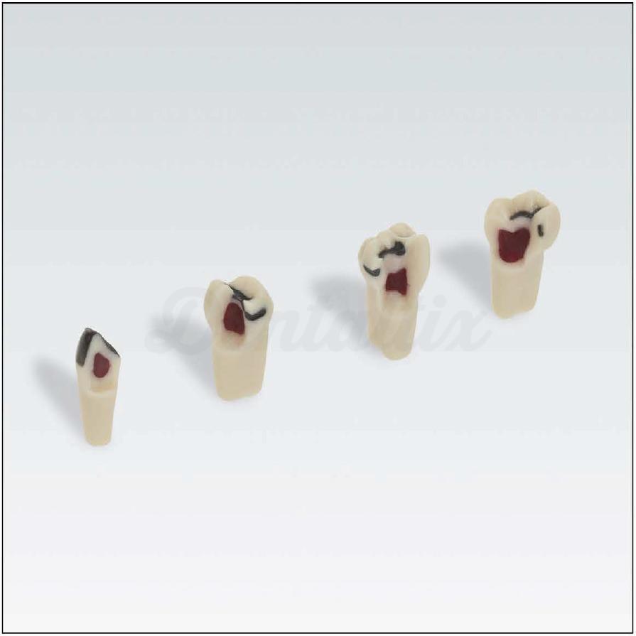 Dent N° 85 pour typodont avec pulpe remplie de cire et carie
