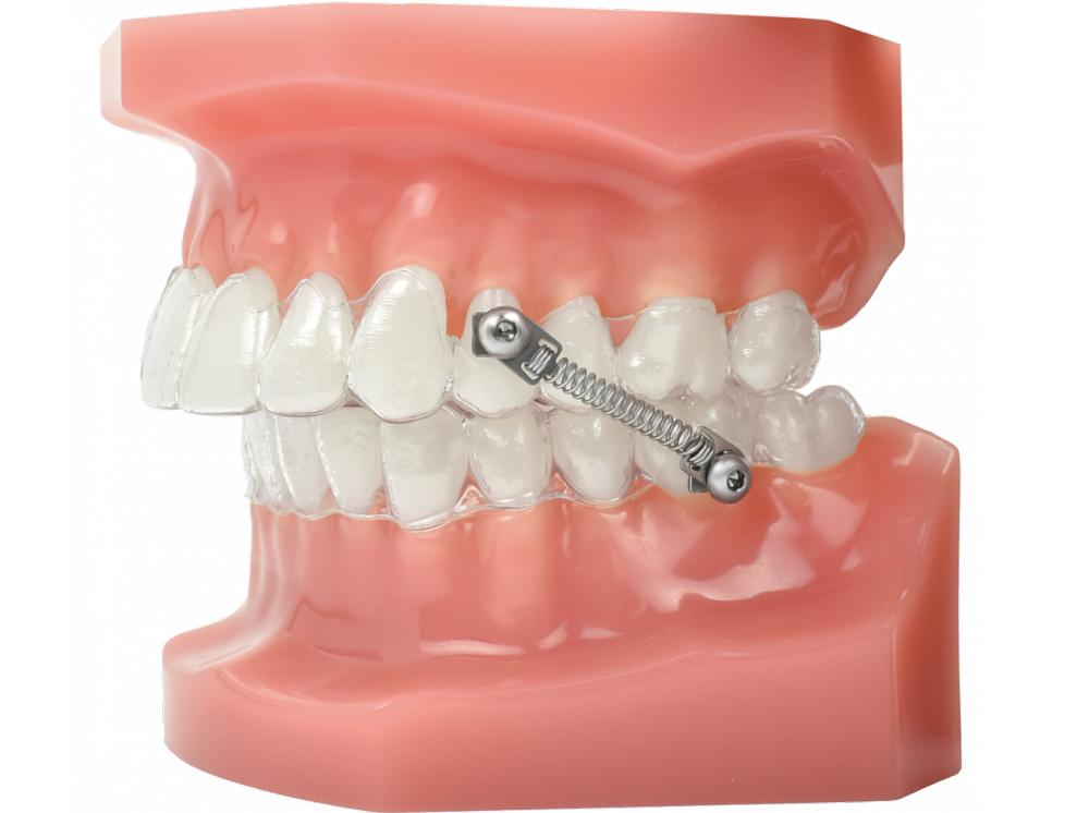 CS5™ Bondable System, 5 Patient Kit - 10 mm