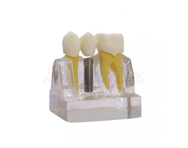 Modèle de démonstration implants-ponts