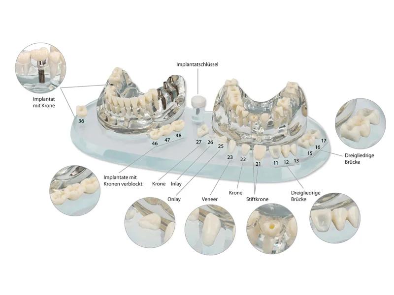 Modèle d´étude Demo Implant C+B
