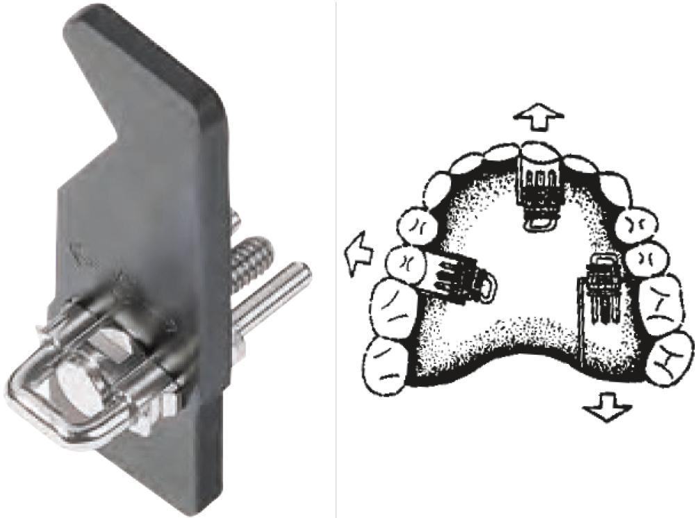 Vis d'expansion squelettique droite 5mm 10pc