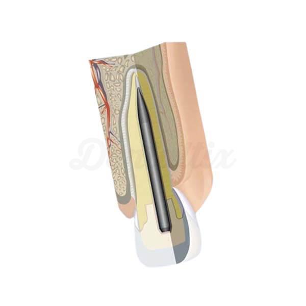 Mirafit Carbone : Poteau de reconstruction sans fil (6 pièces)