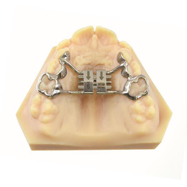 Vis d'expansion rapide CAD-CAM Tooth Borne