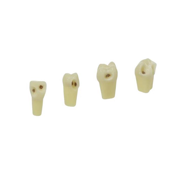 Frasaco Tandmodel Tweelaags met Cariës ANA-4 ZSDK 301 V1 - Tand 25 (1 st.)