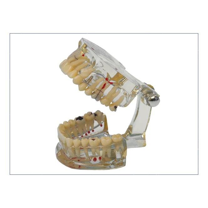 Modele D Etude Dents Malades