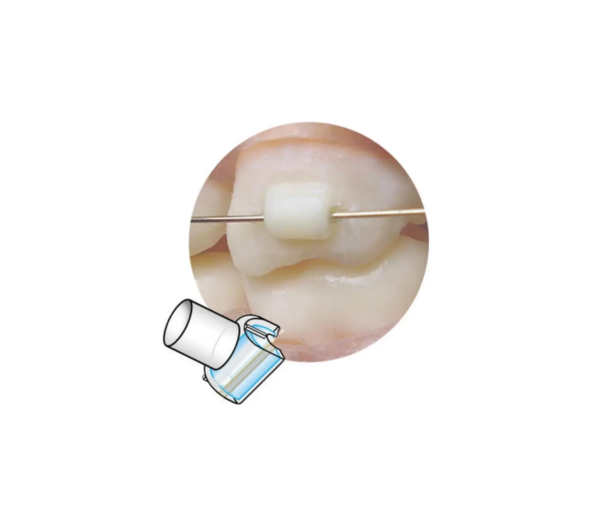 Capsule Mini Mold pour Tube Temporaire (10)
