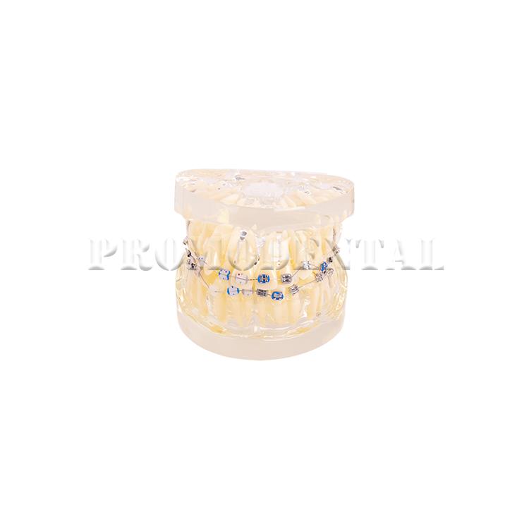 Modèle de dents Ortho Métal & Céramique
