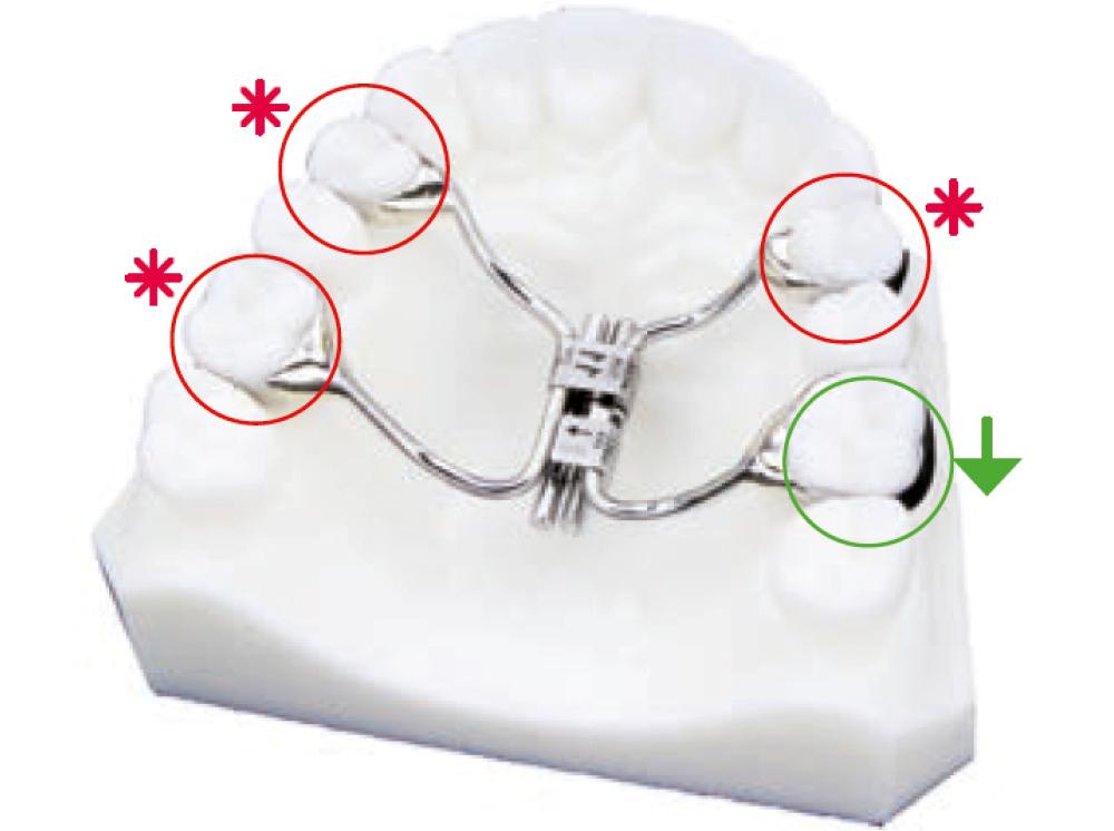 Multifunctional orthodontic screw, 4 arms, left