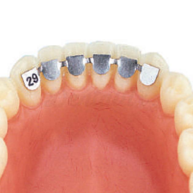 Assortiment orthodontie linguale (10 unités)