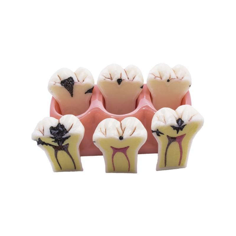 Modèle Amovible de Caries